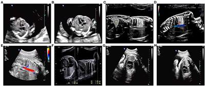 Case Report: Paternal Uniparental Isodisomy and Heterodisomy of Chromosome 16 With a Normal Phenotype